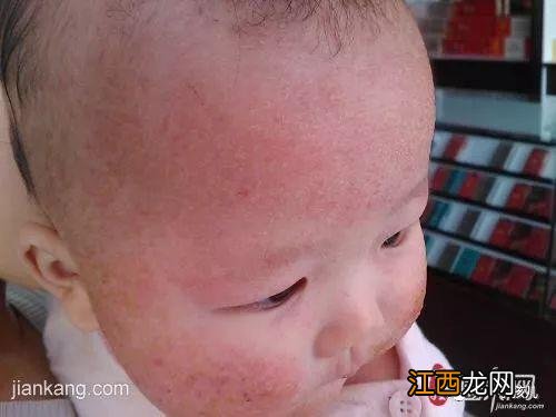 泛发性湿疹图片 对称性湿疹图片