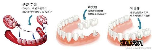 拔蛀牙一般多少钱一颗 蛀牙已经烂空了怎么办