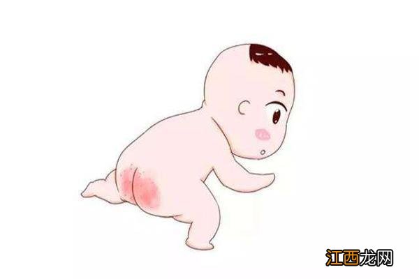 婴儿红屁屁