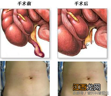 阑尾位置图解6 阑尾位置图