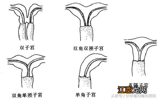 双角子宫能正常生育吗 弓形子宫能正常生育吗