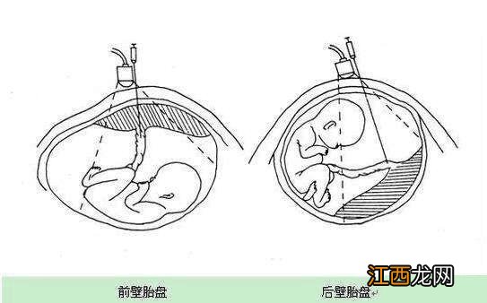 胎盘后壁和前壁有什么区别 胎盘后壁