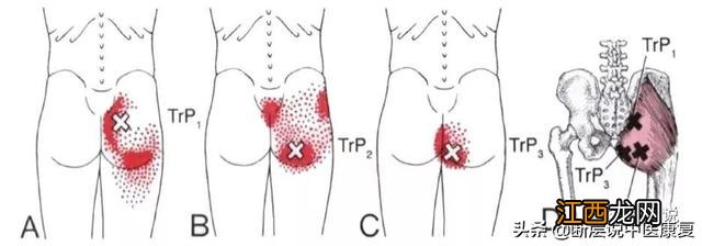 坐骨神经痛怎么治疗方法最快 臀部穴位图