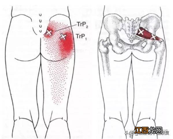 坐骨神经痛怎么治疗方法最快 臀部穴位图