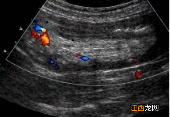 空气灌肠后,肠套叠已复位的表现有 空气灌肠