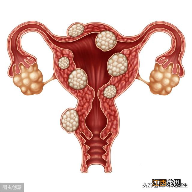 子宫粘膜下肌瘤2型严重吗 子宫黏膜下肌瘤