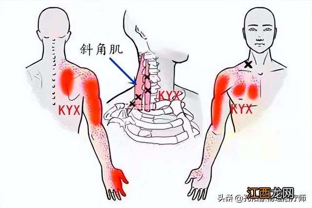 肩膀酸痛是什么原因引起的