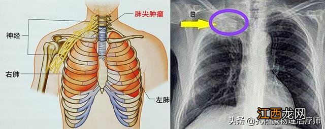 肩膀酸痛是什么原因引起的