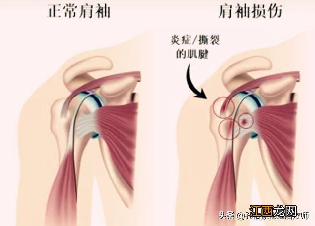 肩膀酸痛是什么原因引起的