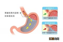 孩子反流性食管炎症状表现有哪些 反流性食管炎症状表现有哪些