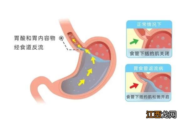 孩子反流性食管炎症状表现有哪些 反流性食管炎症状表现有哪些