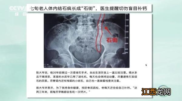 体内钙多了会怎么样 钙多了会怎么样