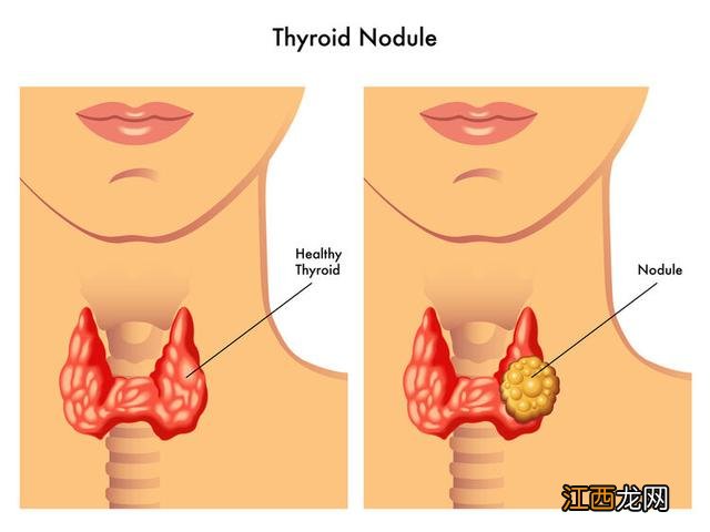 甲状腺结节三级是什么程度 甲状腺3级