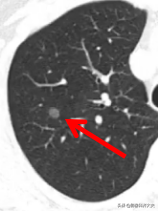 肺部磨玻璃结节是什么意思严重吗多发 肺部磨玻璃结节是什么意思