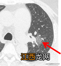 肺部磨玻璃结节是什么意思严重吗多发 肺部磨玻璃结节是什么意思