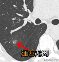 肺部磨玻璃结节是什么意思严重吗多发 肺部磨玻璃结节是什么意思