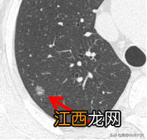 肺部磨玻璃结节是什么意思严重吗多发 肺部磨玻璃结节是什么意思