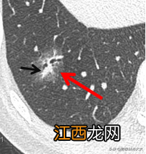 肺部磨玻璃结节是什么意思严重吗多发 肺部磨玻璃结节是什么意思