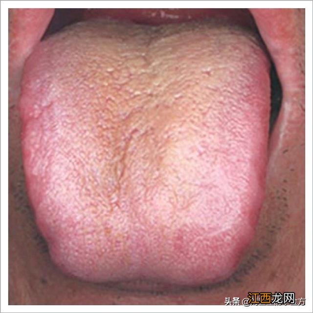 中医舌诊图解大全 舌苔病症大全图解