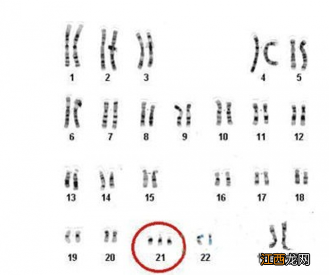 唐氏综合症图片 特征 唐氏综合症图片
