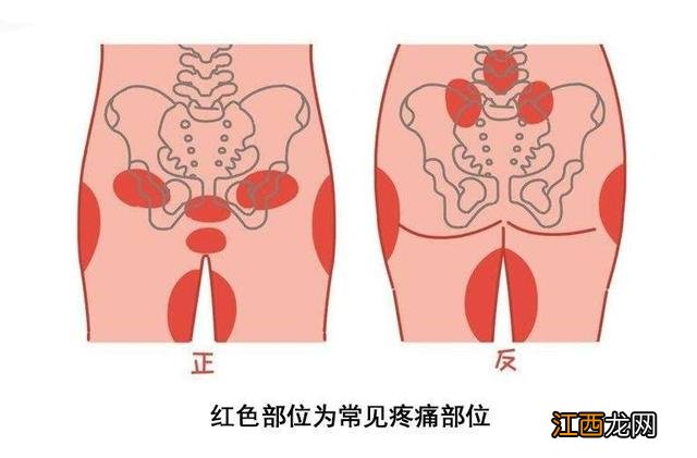 耻骨疼怎么缓解 耻骨疼在哪个位置图片