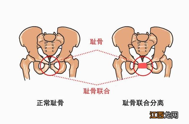 耻骨疼怎么缓解 耻骨疼在哪个位置图片