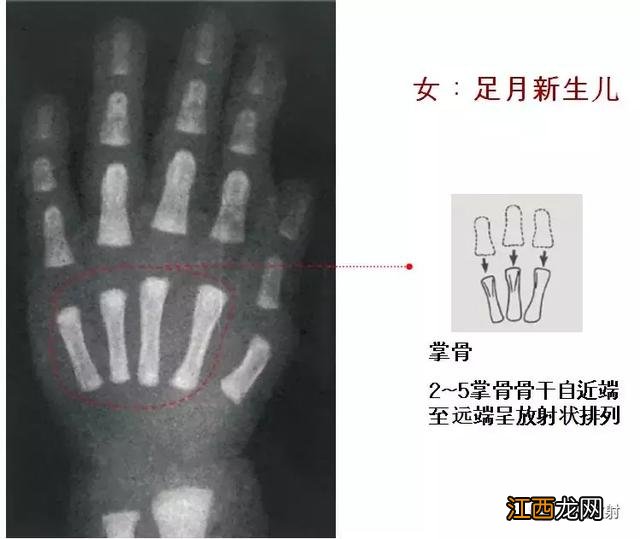 骨龄预测身高图早熟2.3岁11岁154 骨龄预测身高图