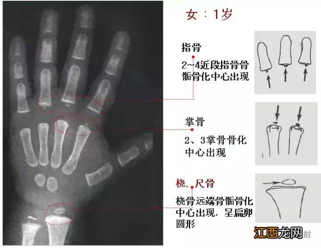 骨龄预测身高图早熟2.3岁11岁154 骨龄预测身高图