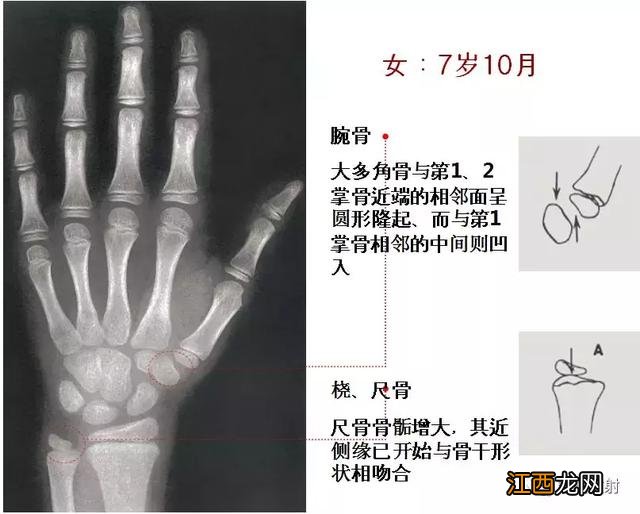 骨龄预测身高图早熟2.3岁11岁154 骨龄预测身高图