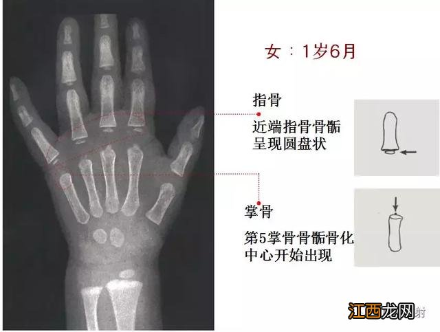 骨龄预测身高图早熟2.3岁11岁154 骨龄预测身高图