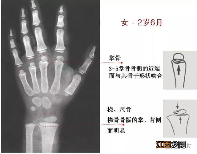 骨龄预测身高图早熟2.3岁11岁154 骨龄预测身高图