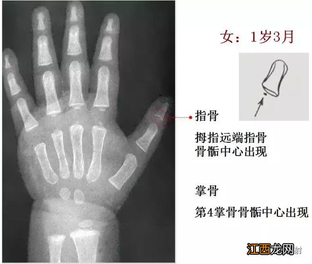 骨龄预测身高图早熟2.3岁11岁154 骨龄预测身高图