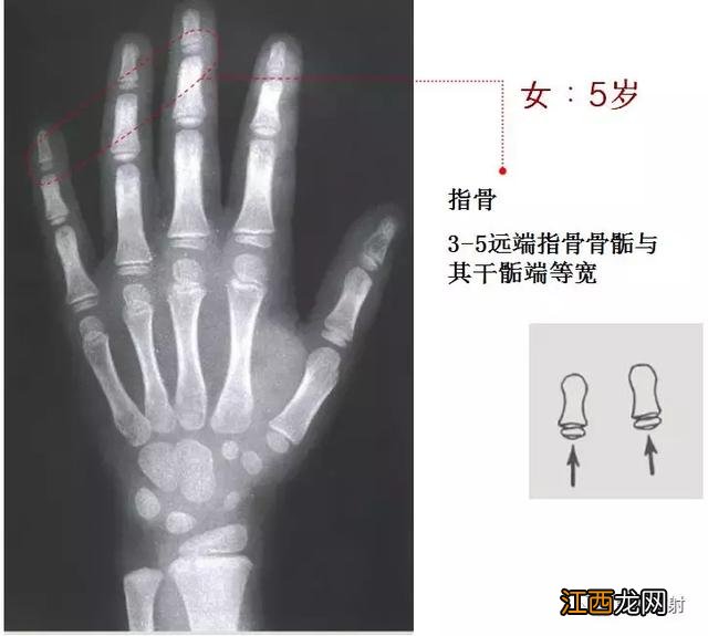 骨龄预测身高图早熟2.3岁11岁154 骨龄预测身高图