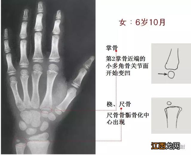 骨龄预测身高图早熟2.3岁11岁154 骨龄预测身高图