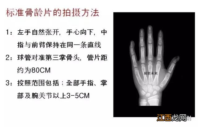 骨龄预测身高图早熟2.3岁11岁154 骨龄预测身高图