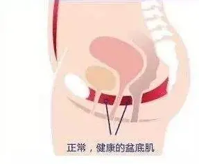 医院产后盆底肌修复费用 剖腹产需要做盆底肌修复吗