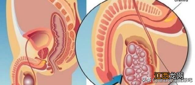 睾丸变硬变大又胀又痛吃啥药 睾丸变硬