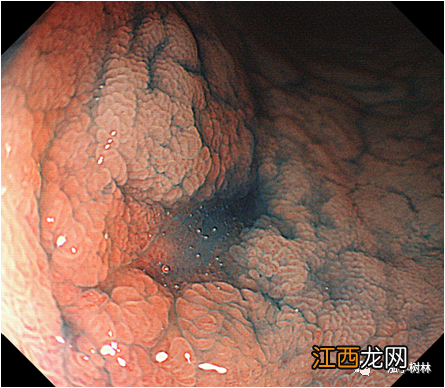 胃窦在哪里位置图片 胃窦在哪里