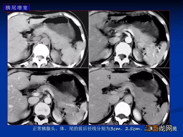 胰腺是哪个部位疼图片 胰腺是哪个部位