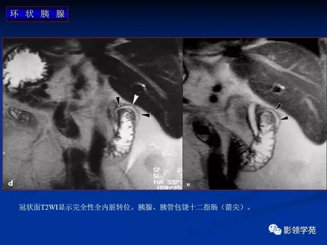 胰腺是哪个部位疼图片 胰腺是哪个部位