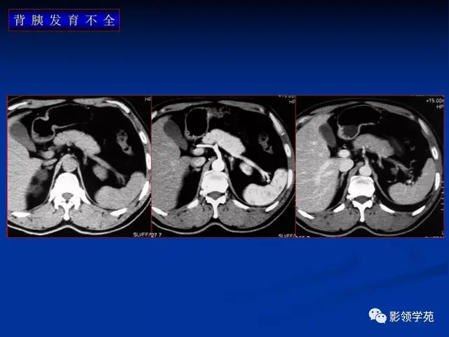 胰腺是哪个部位疼图片 胰腺是哪个部位