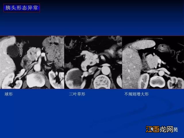 胰腺是哪个部位疼图片 胰腺是哪个部位