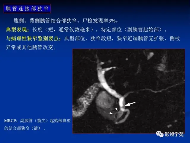 胰腺是哪个部位疼图片 胰腺是哪个部位