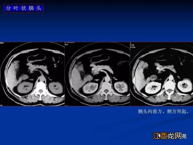 胰腺是哪个部位疼图片 胰腺是哪个部位