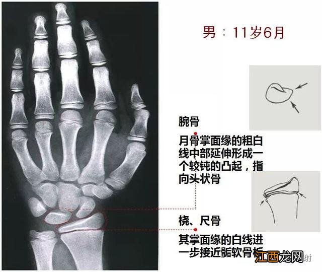 tw3骨龄对照表 骨龄对照表