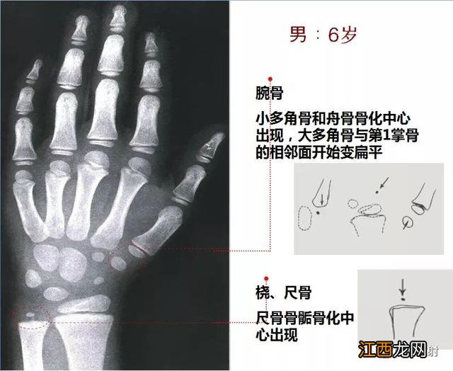 tw3骨龄对照表 骨龄对照表