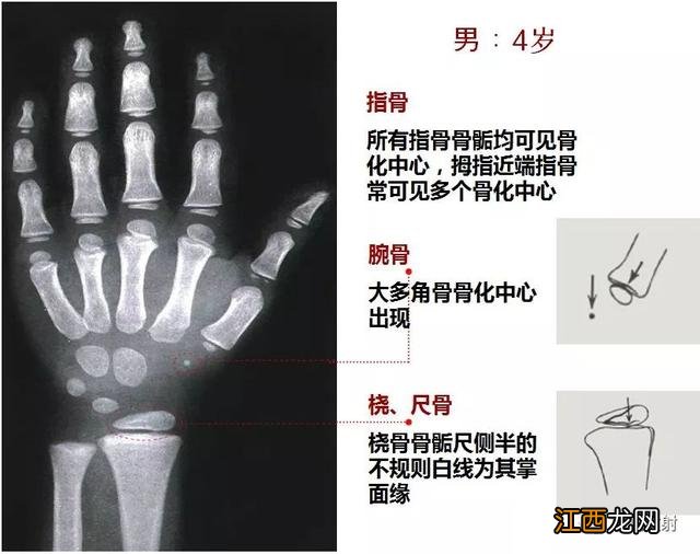 tw3骨龄对照表 骨龄对照表