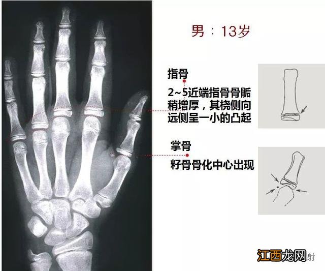 tw3骨龄对照表 骨龄对照表