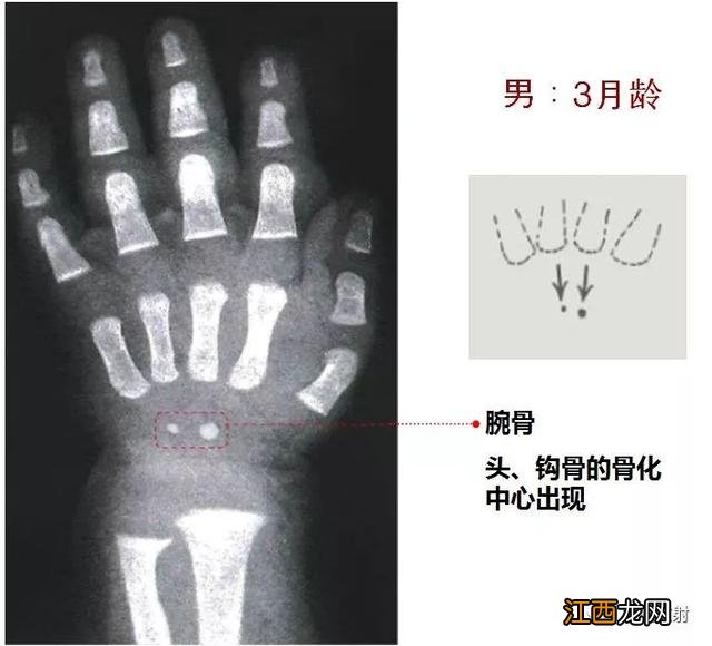 tw3骨龄对照表 骨龄对照表