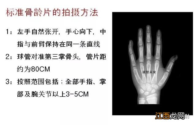 tw3骨龄对照表 骨龄对照表